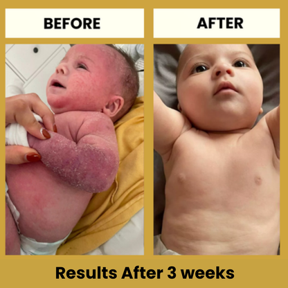 LittleSkin Eczema Cream