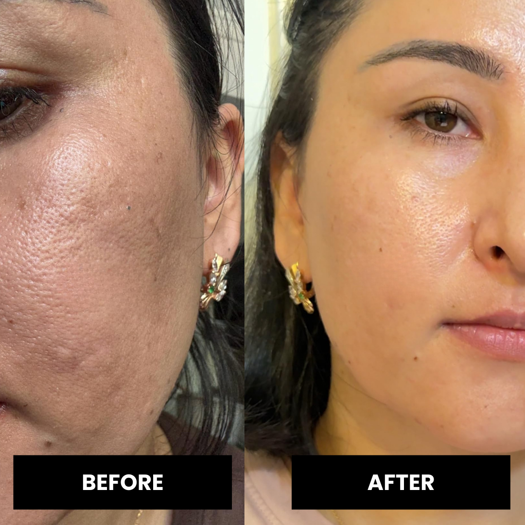 RetinaLift™ Shot