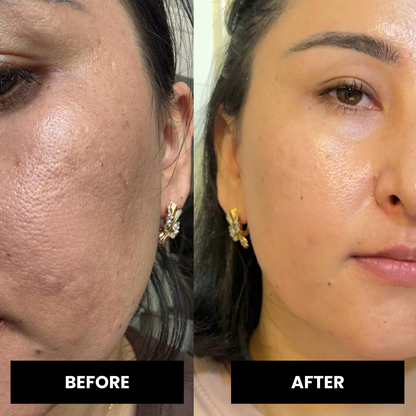 RetinaLift™ Shot
