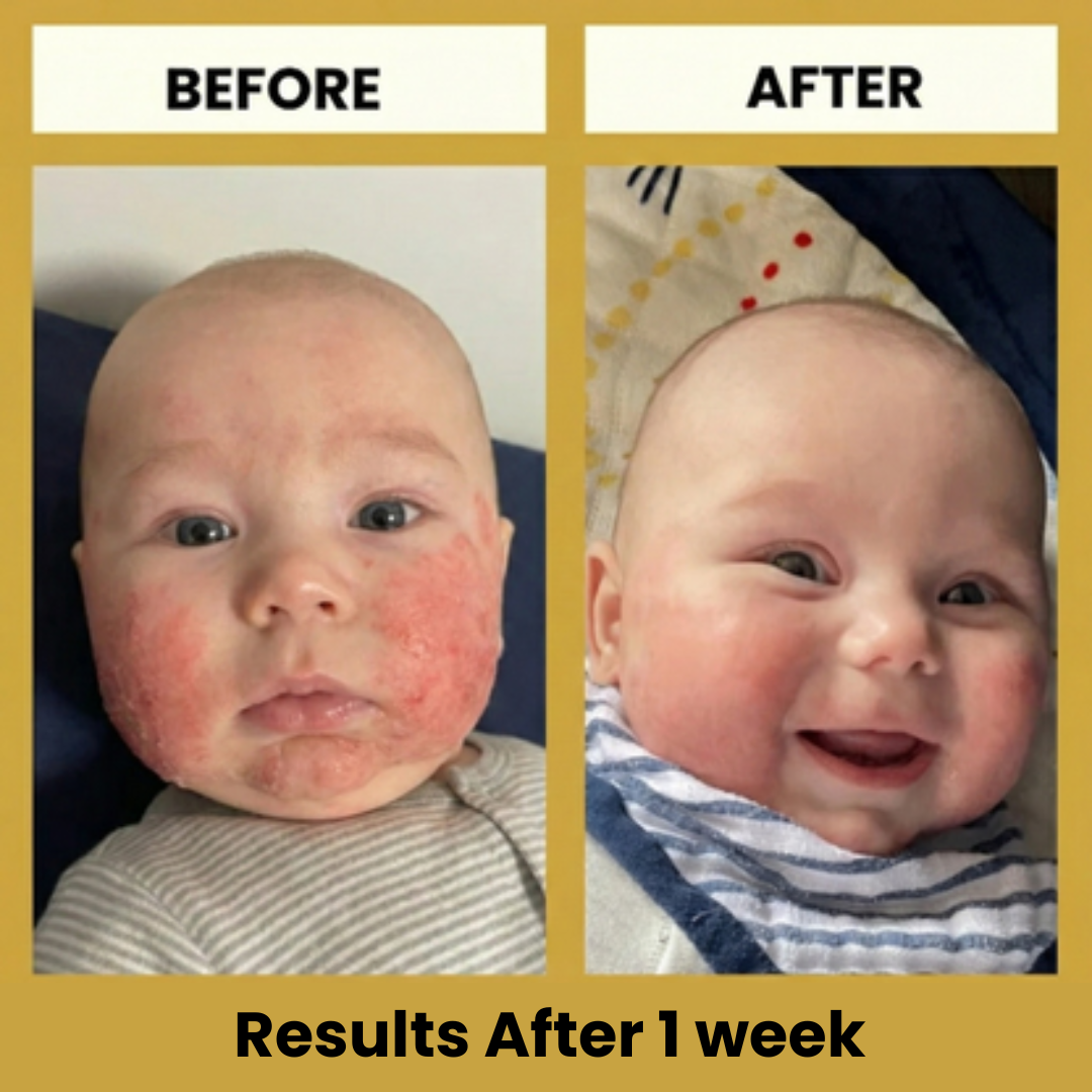 LittleSkin Eczema Cream