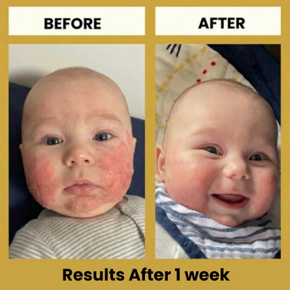 LittleSkin Eczema Cream