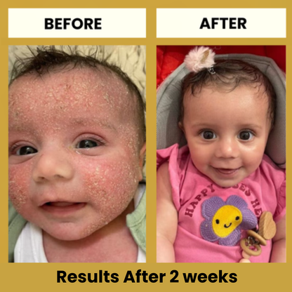 LittleSkin Eczema Cream
