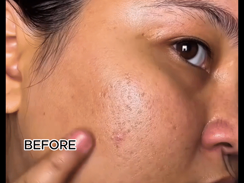 LOVILDS™ Facial Cream with 7% Arbutin + 4% Tranexamic Acid
