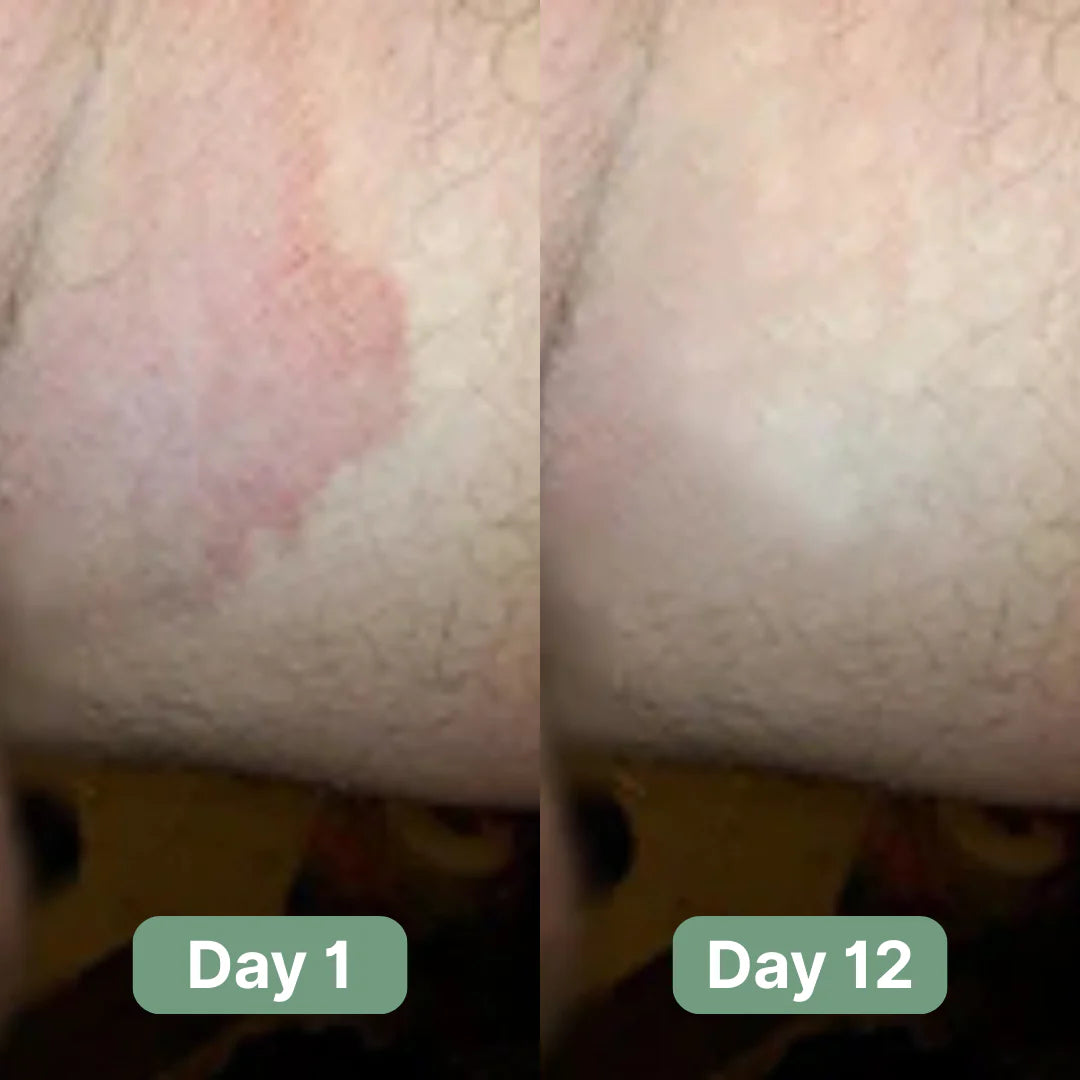 Noventa AntiFungal Bar™