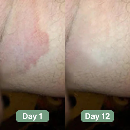 Noventa AntiFungal Bar™