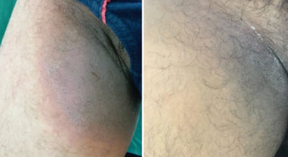 Noventa AntiFungal Bar™