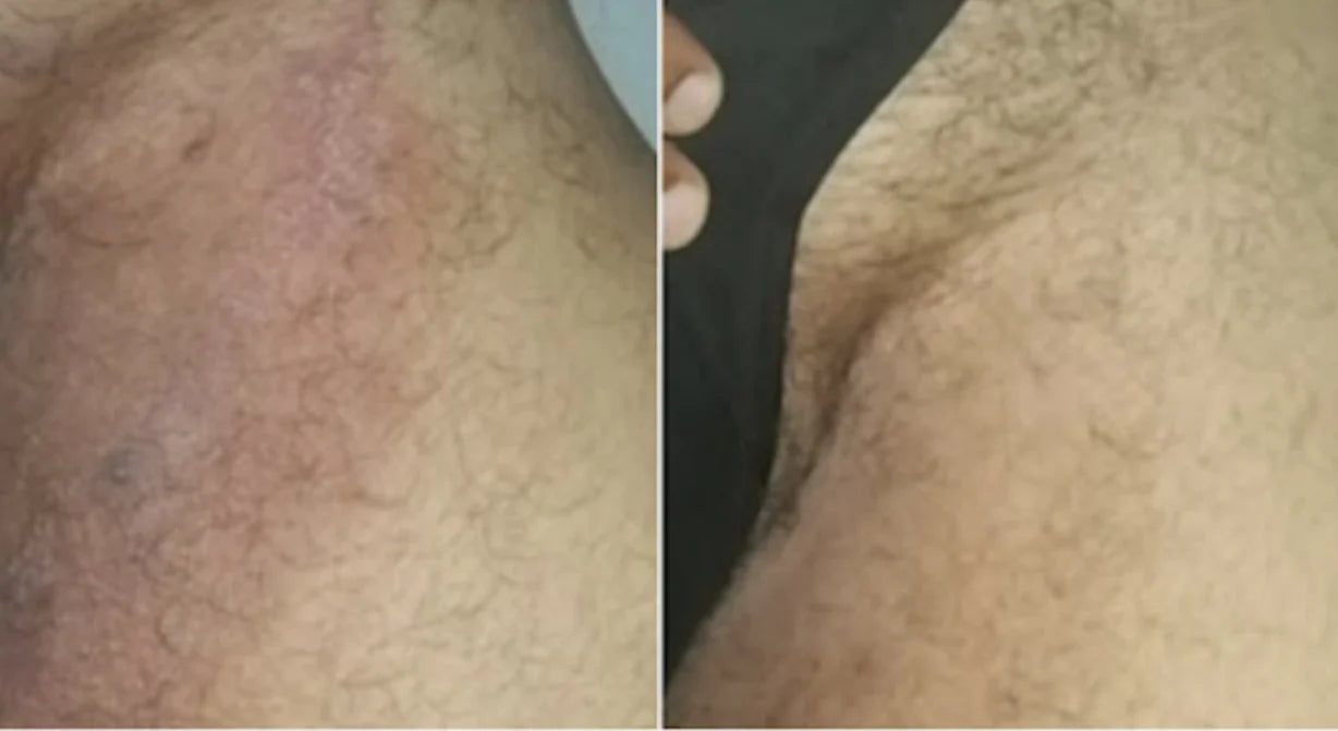 Noventa AntiFungal Bar™