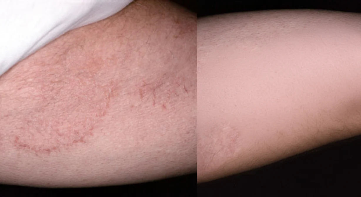 Noventa AntiFungal Bar™