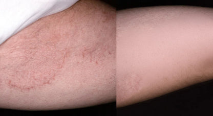 Noventa AntiFungal Bar™